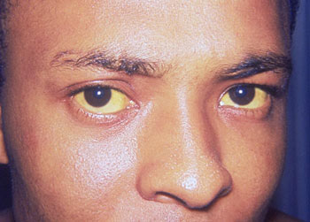 In acute hepatitis the whites of the eyes go yellowish and the skin goes yelowish as well.