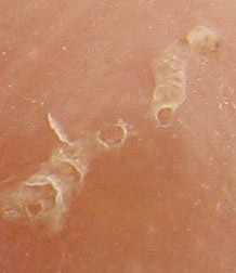 scabies burrow